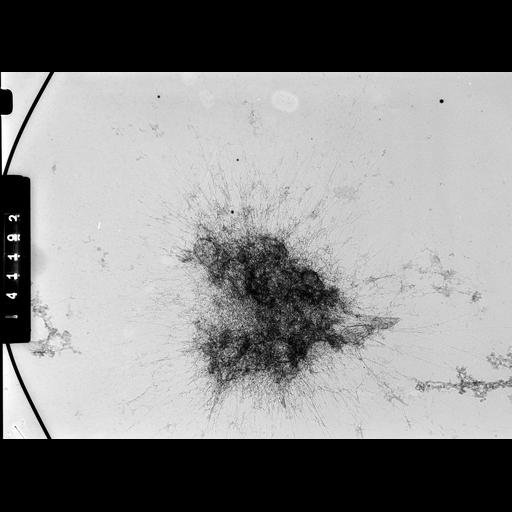 cevical carcinoma