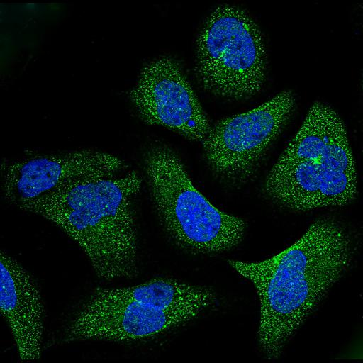 osteocarcinoma